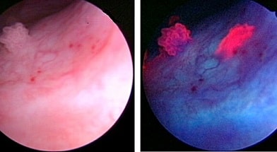 Фотодинамическая диагностика рака мочевого пузыря