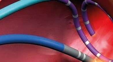 Катетерная абляция и электрофизиологическое исследование (ЭФИ) сердца