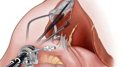 Лапароскопическая хирургия для лечения рака предстательной железы
